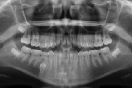 Dental Health: X-Rays