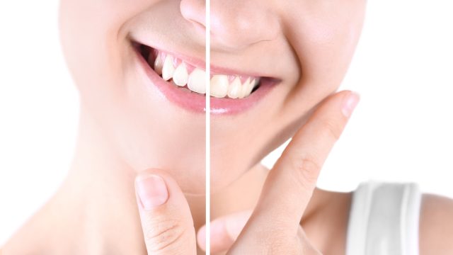 San Marcos Teeth Whitening: Myths vs. Facts