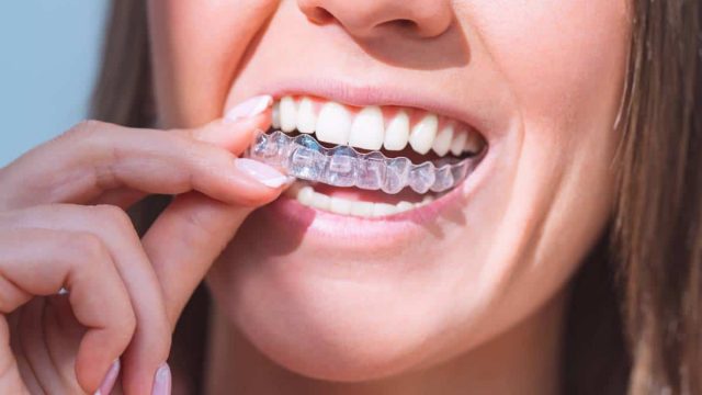 San Marcos Invisalign – A Path to Straighter Teeth