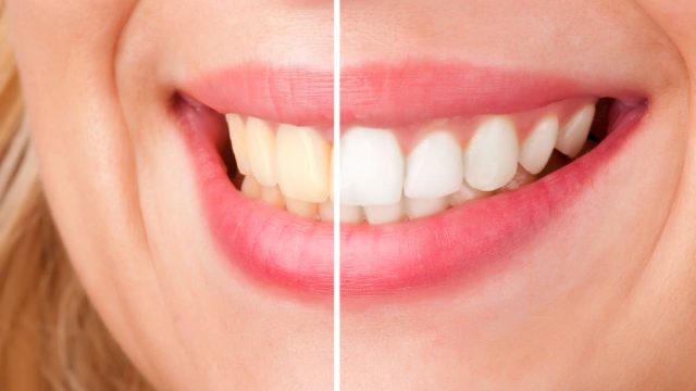 Professional Teeth Whitening: Why Trusting a Dentist Yields the Best Results 