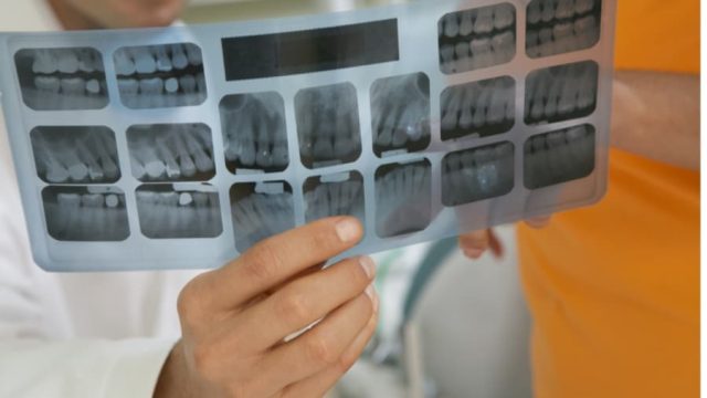 Different Types of Fillings and Why You May Need Them