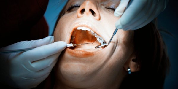The Dangers of Mercury Dental Fillings in San Marcos TX