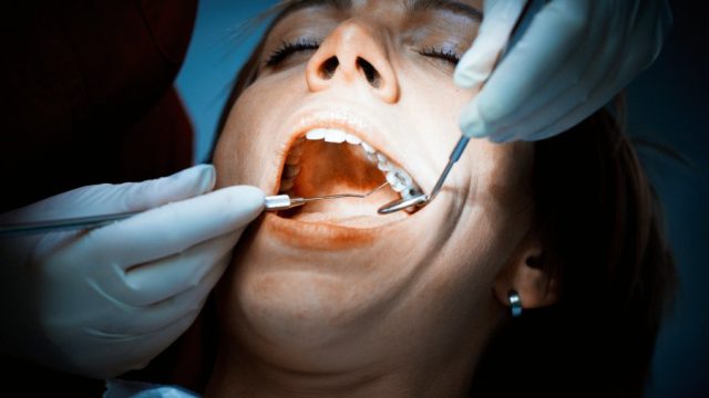 The Dangers of Mercury Dental Fillings in San Marcos TX