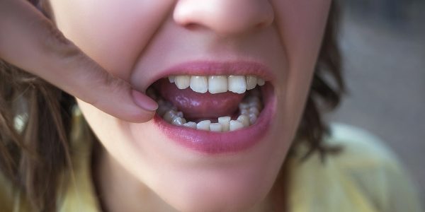 Is It Possible To Get San Marcos Veneers With Crooked Teeth?
