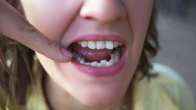 Is It Possible To Get San Marcos Veneers With Crooked Teeth?