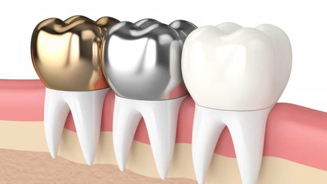 Types of Dental Crowns