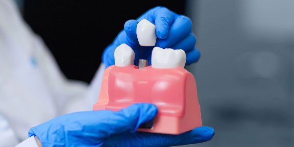 San Marcos Dental Implant Questions Answered: What to Expect