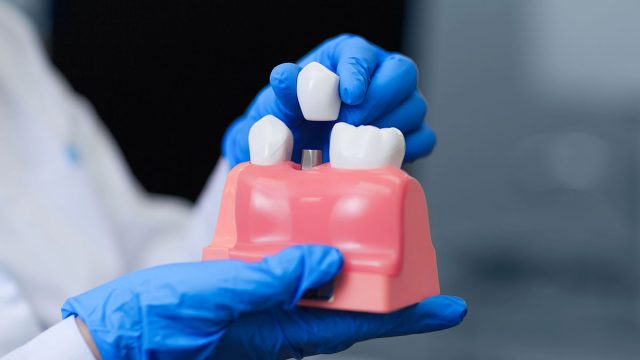 San Marcos Dental Implant Questions Answered: What to Expect