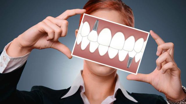 The Benefits & Installation Process of Dental Implants