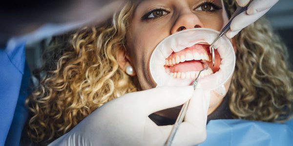 San Marcos Veneers vs Bonding: Fixing Small Chips and Gaps