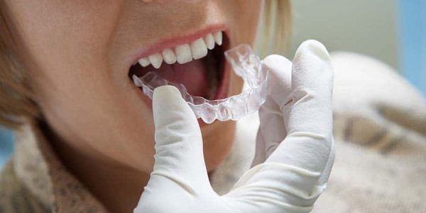 Invisalign for Straightening Your Teeth