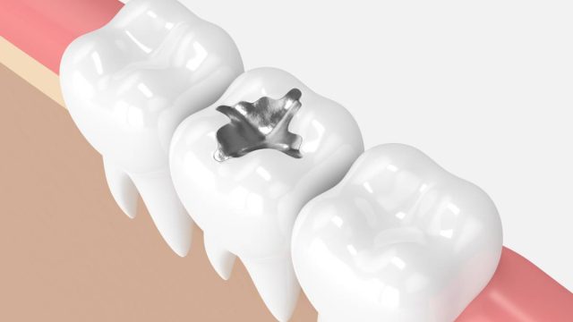 Are Silver Fillings Really Made of Silver?