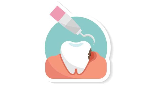 Tips to Help Prevent & Treat Tooth Decay