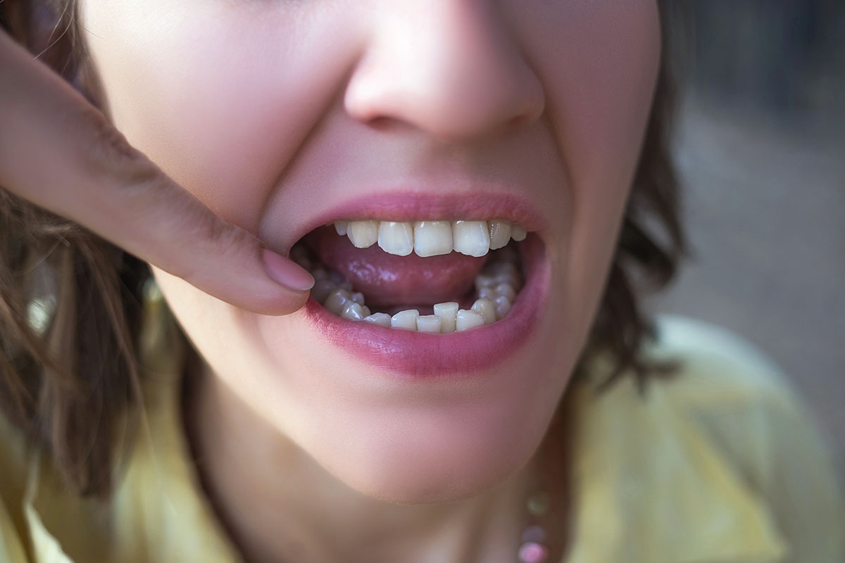 A woman showing her teeth, potential candidate for San Marcos veneers.