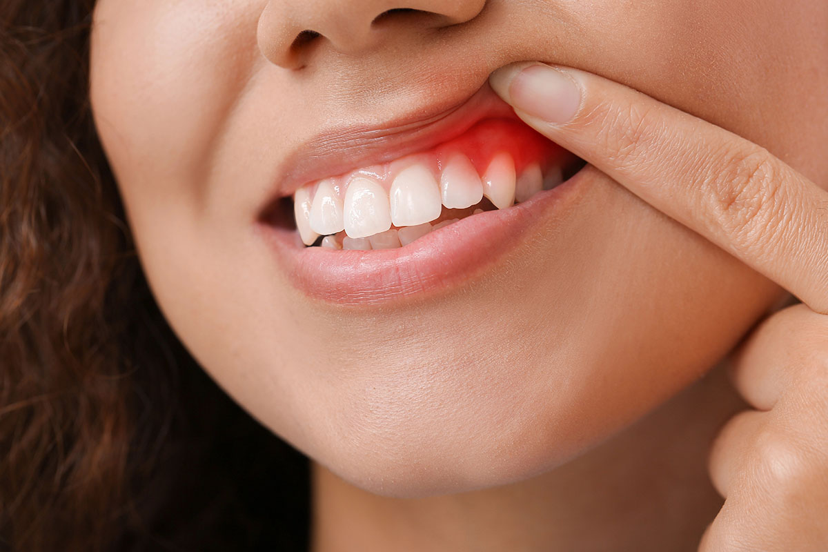 Close-up of a woman's face showing her smiling with healthy teeth, while her finger pulls back her gum, revealing inflammation and redness along the gum line.