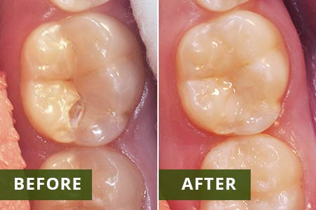 Dental Health: Tooth Sealant